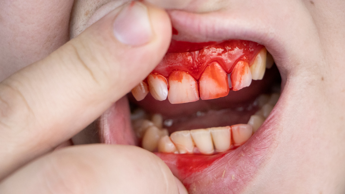 Bleeding gums